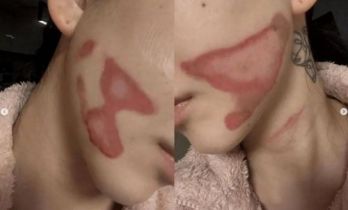 权珉娥做医美导致面度灼伤 正在准备提起诉讼